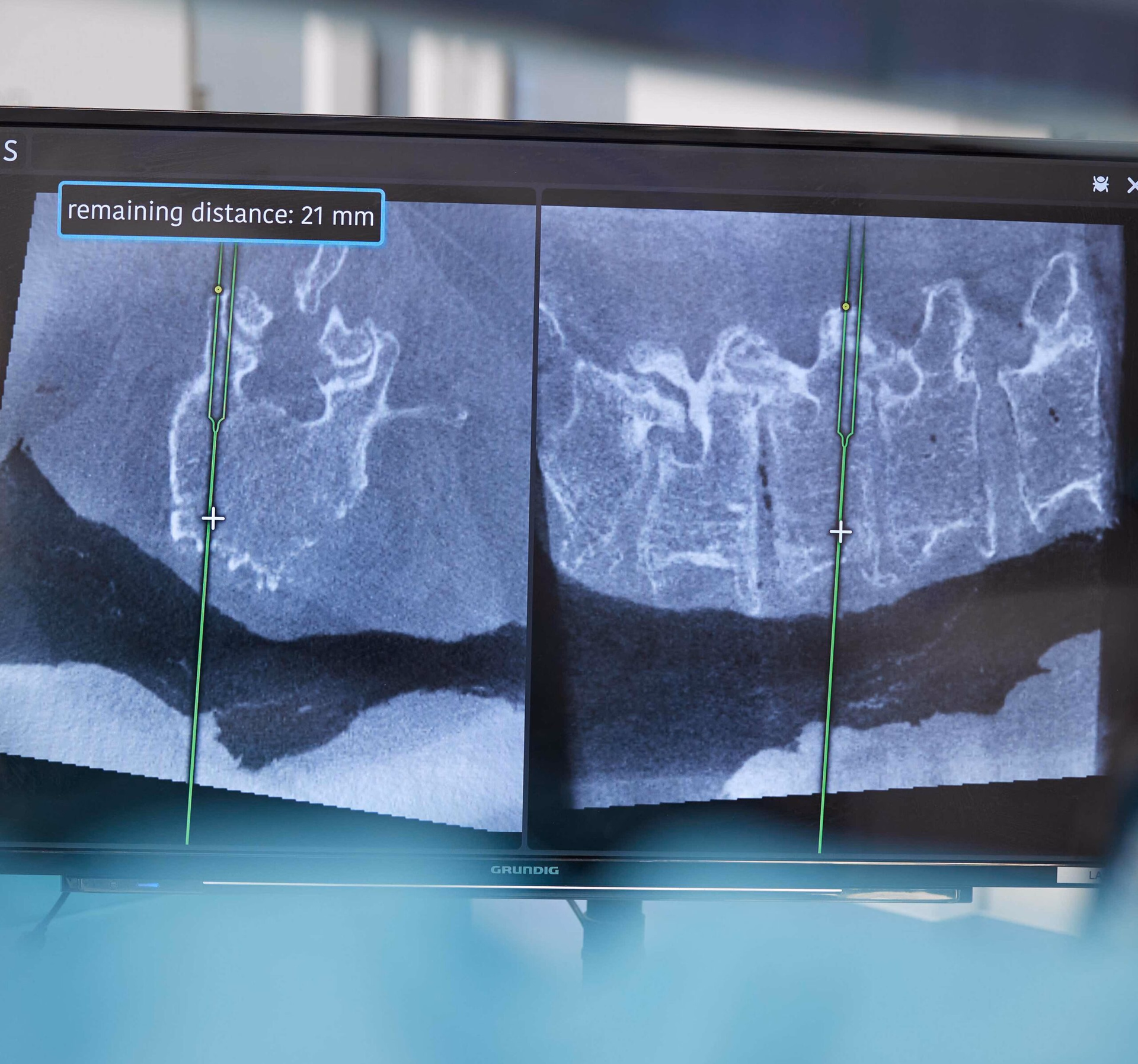 Revolutionary AI-powered surgery